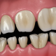 Dental Bone Spur Pictures